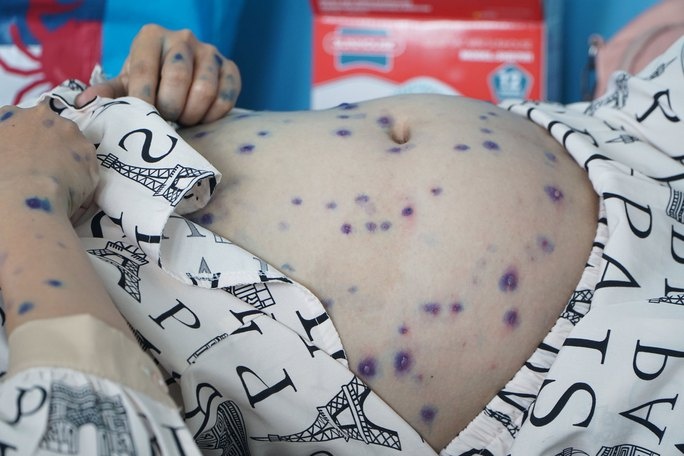 Hang tram nguoi mac thuy dau, nhieu ca nang hinh anh