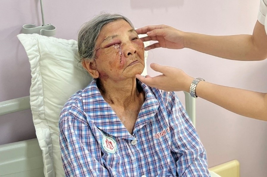 Phat hien ung thu da tu not ruoi o mi mat hinh anh