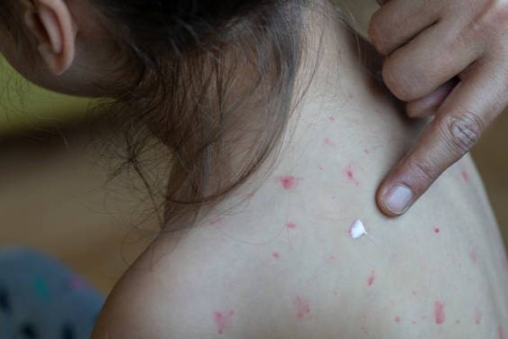 Tai sao chich ngua soi roi ma van mac benh? hinh anh