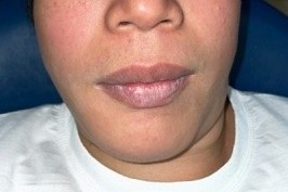 Lech mat vi nang xuong ham hinh anh