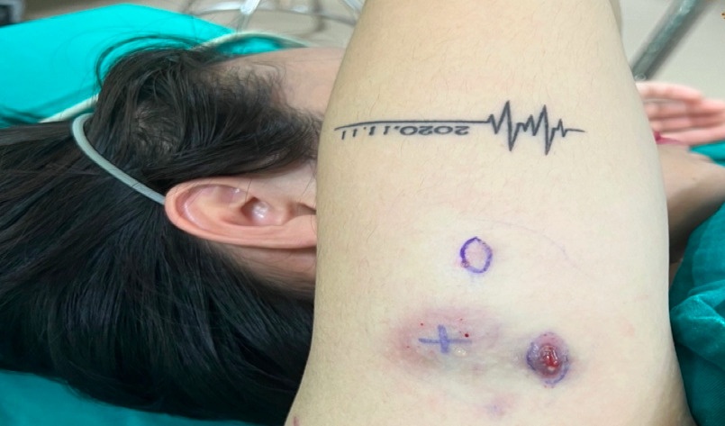 Noi u cuc khap nguoi sau khi tiem tan mo giam beo o 'spa nguoi quen' hinh anh