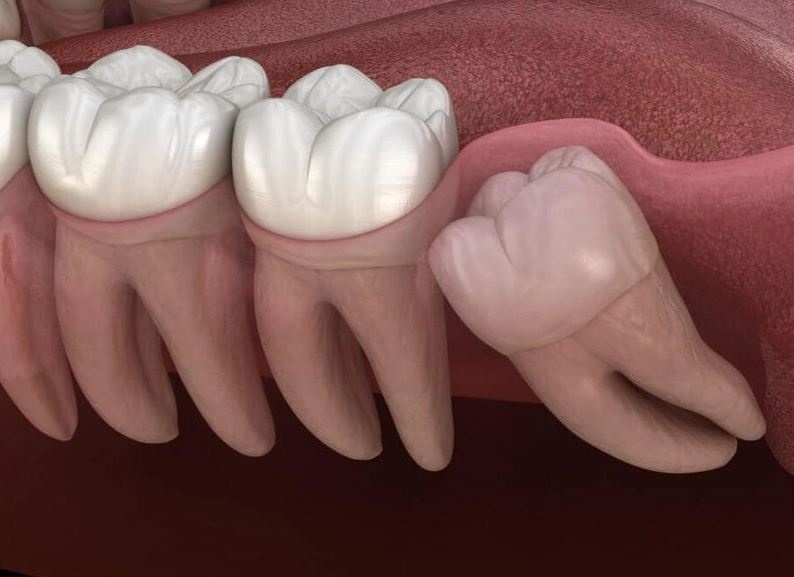 Rang moc ngam: Nguyen nhan, bieu hien va dieu tri hinh anh