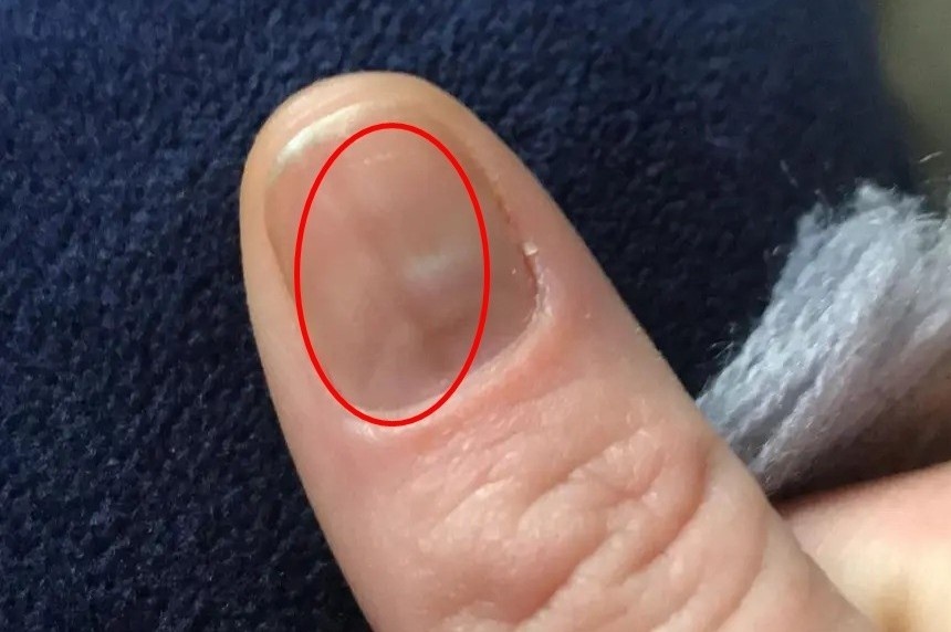 Phat hien ung thu qua vet bam tren mong tay hinh anh