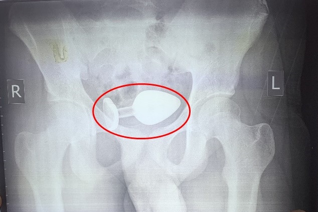 Thieu nien 15 tuoi nhap vien vi ket di vat trong hau mon hinh anh