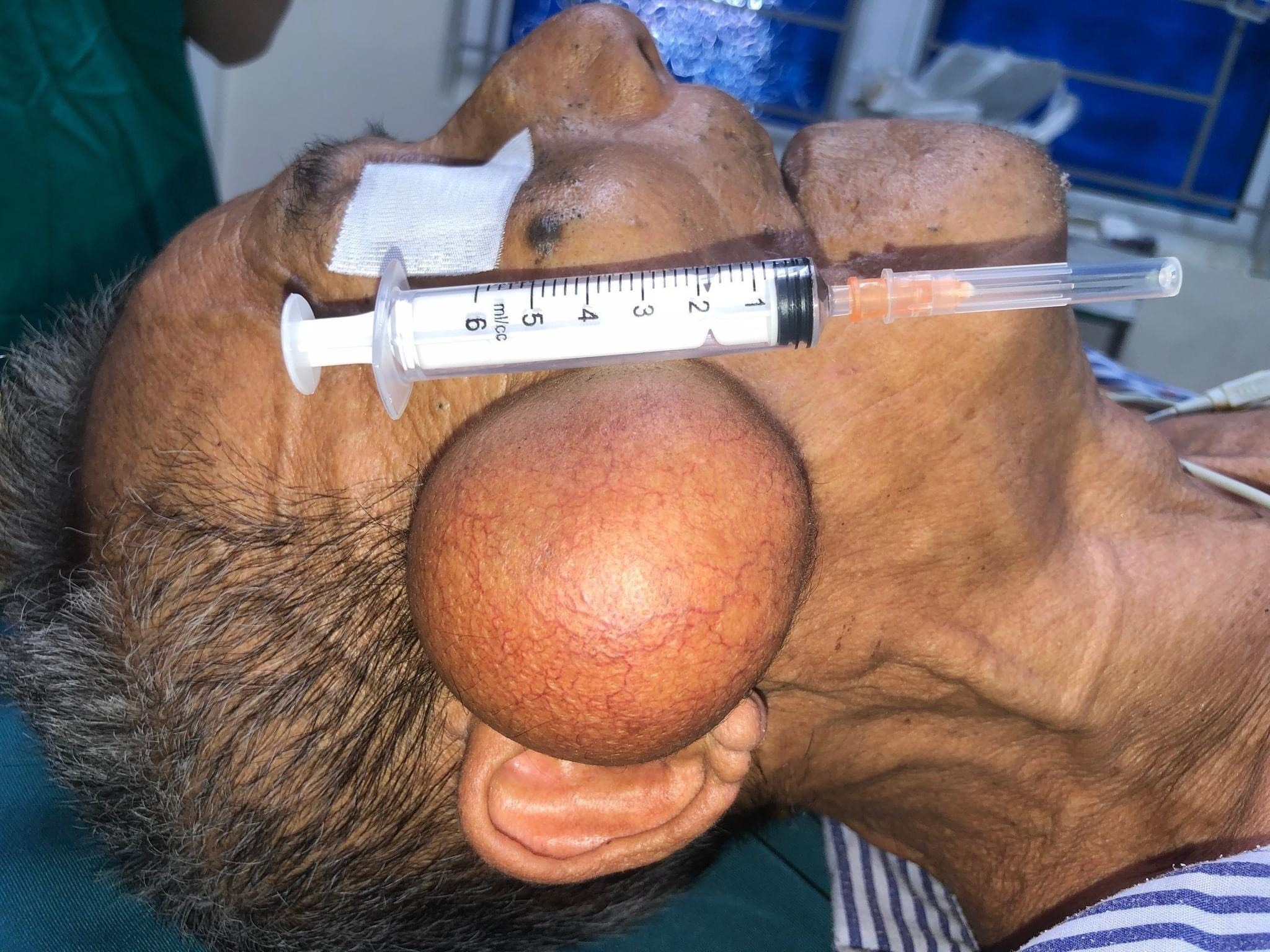 khoi u tren ma anh 2