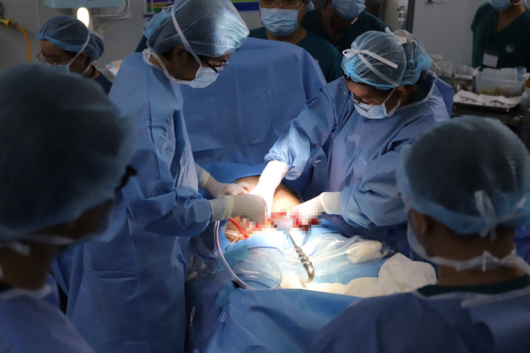 Ca mo than toc cuu be so sinh chua duoc dua ra khoi bung me hinh anh