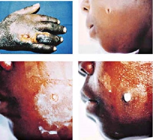 benh than o dien bien anh 1