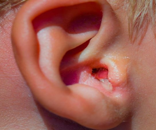 Viem nhiem de gap khi di boi hinh anh