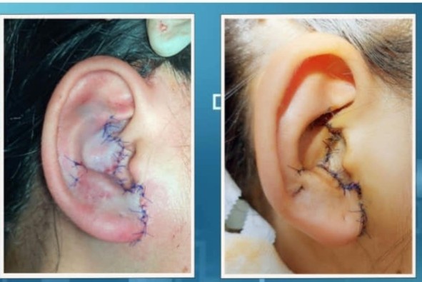 Be gai bi dut gan toan bo tai do tai nan giao thong hinh anh