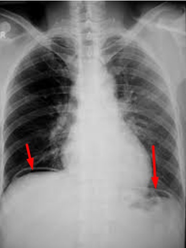 viêm phúc mạc ảnh 2 viem phuc mac anh 2