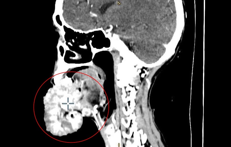ung thu moi duoi anh 1