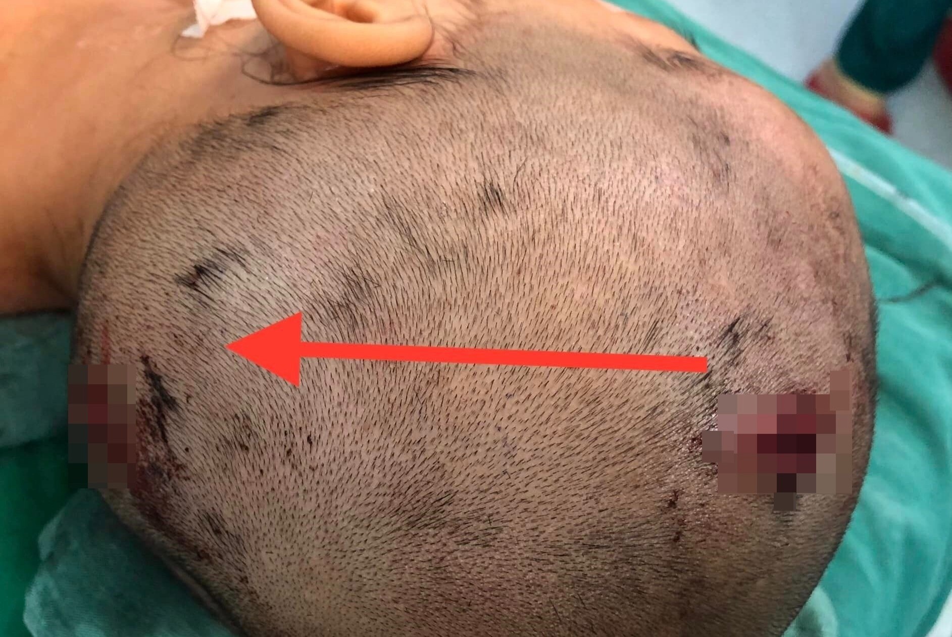 Binh gas mini trong dong rac phat no khien be gai bi vo so hinh anh