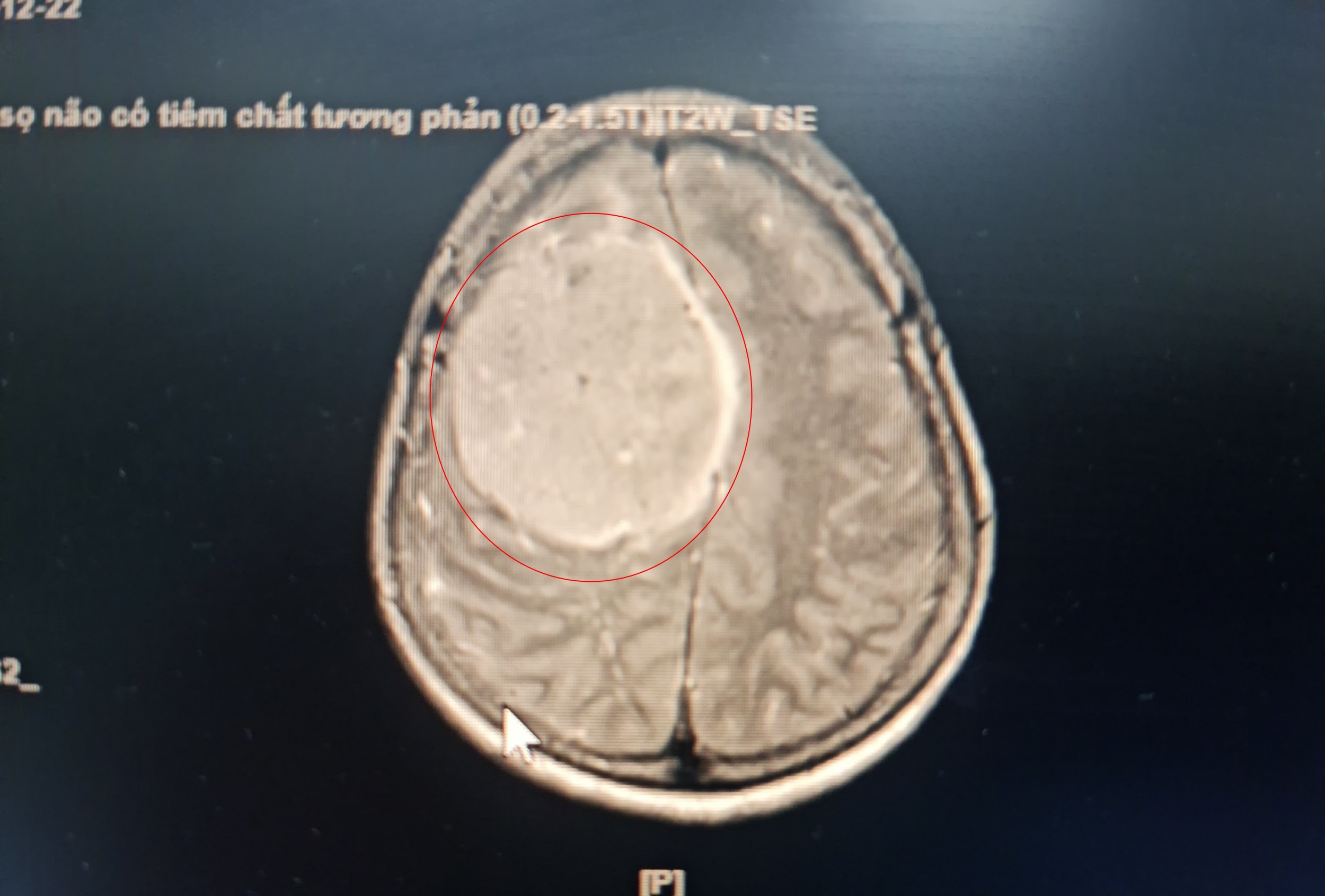 khoi u mang nao anh 1