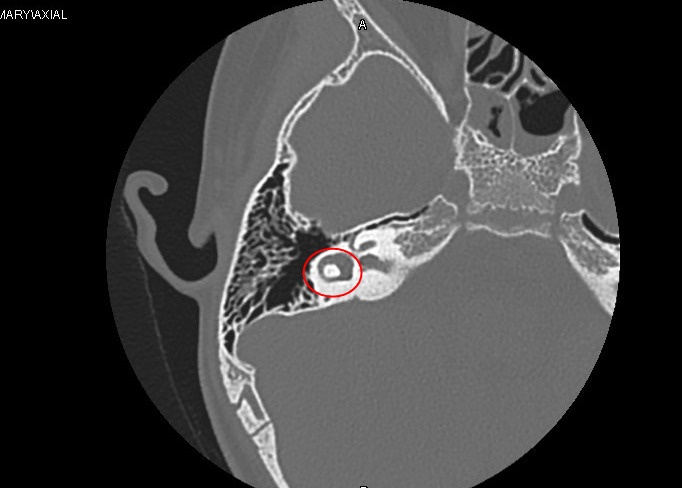 u tai giua bam sinh anh 1