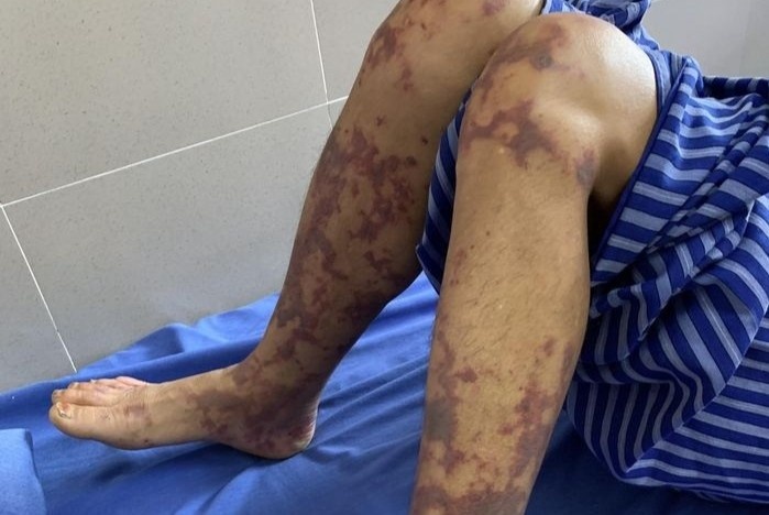 Suyt chet vi mon an ban khap noi o Viet Nam hinh anh