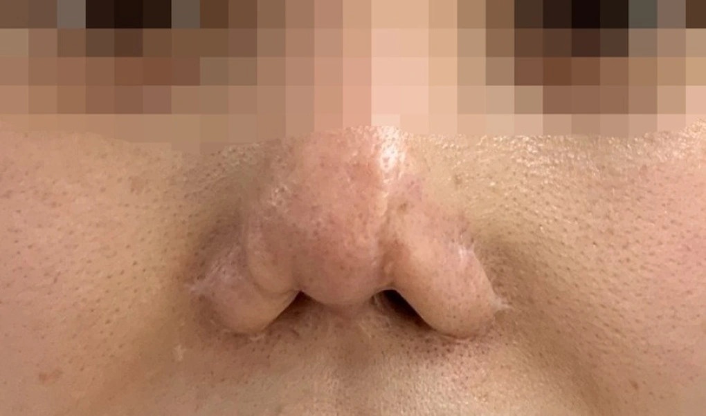 Tam su cua nguoi phu nu 10 lan sua mui hinh anh