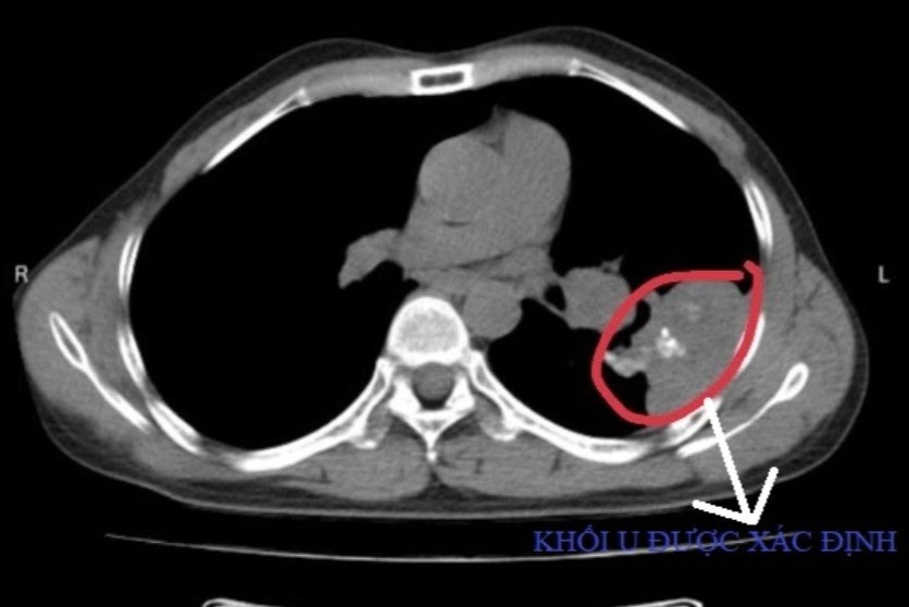 Nhan tin co nguy co mac ung thu phoi chi sau 10 ngay dau nguc, sut can hinh anh