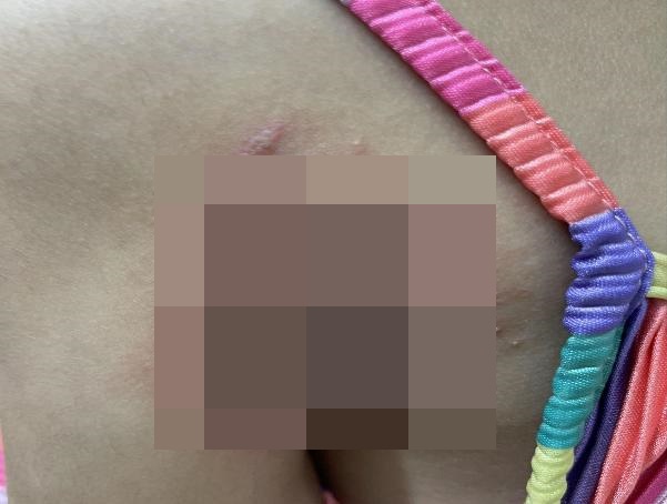 Be gai 8 tuoi bi loet da hoai tu do kien ba khoang hinh anh