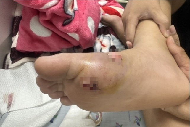 Nam sinh bi coc go dam xuyen ban chan hinh anh