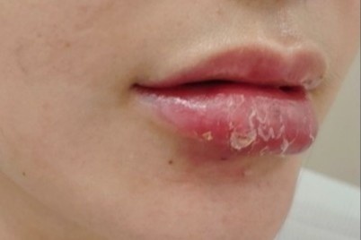 Co gai 25 tuoi nhap vien voi doi moi sung phu sau tiem filler hinh anh