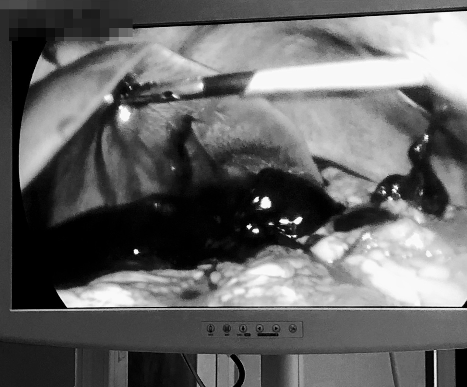 dao dam thau bung anh 1