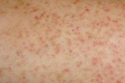 Mac sot xuat huyet het sot da khoi benh chua? hinh anh