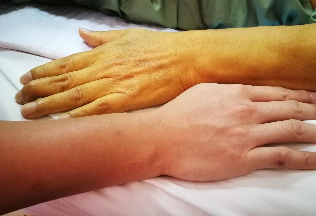 Vang da la dau hieu benh ung thu nao? hinh anh