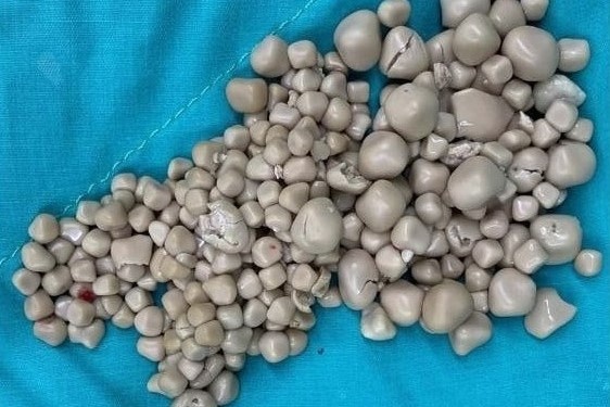 Co gai co 300 vien soi than vi thoi quen hay gap o nguoi tre hinh anh