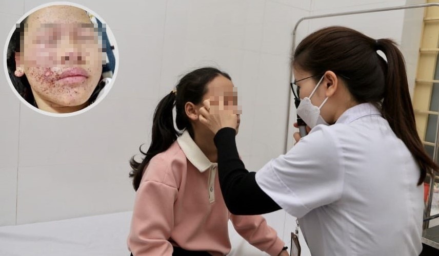 Be gai 11 tuoi bong khap mat vi tu che tao phao hinh anh