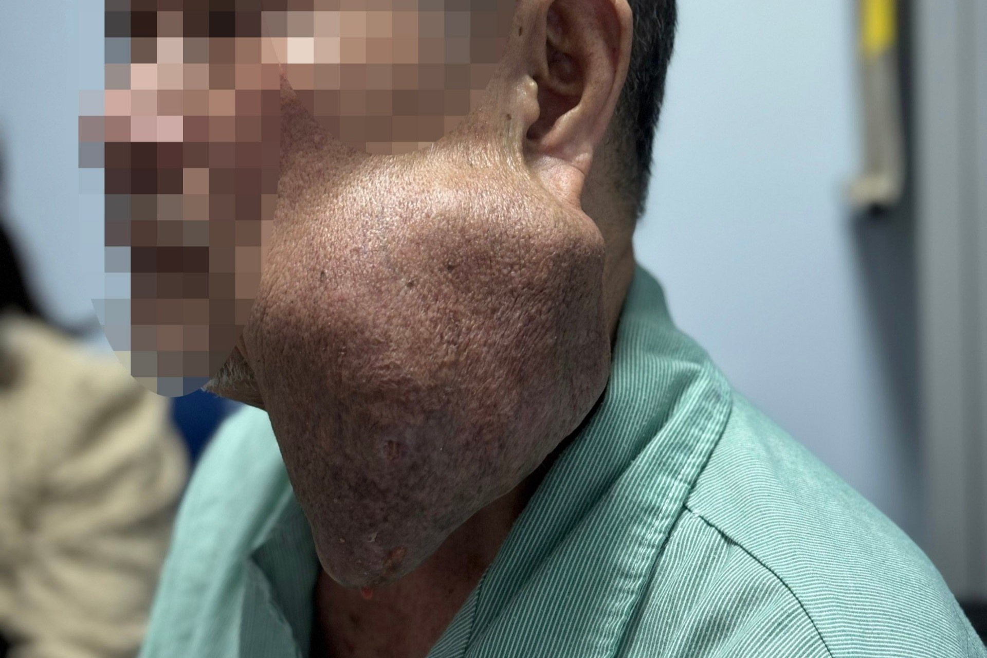 Nguoi dan ong mang khoi u nang 1 kg tren ham hinh anh