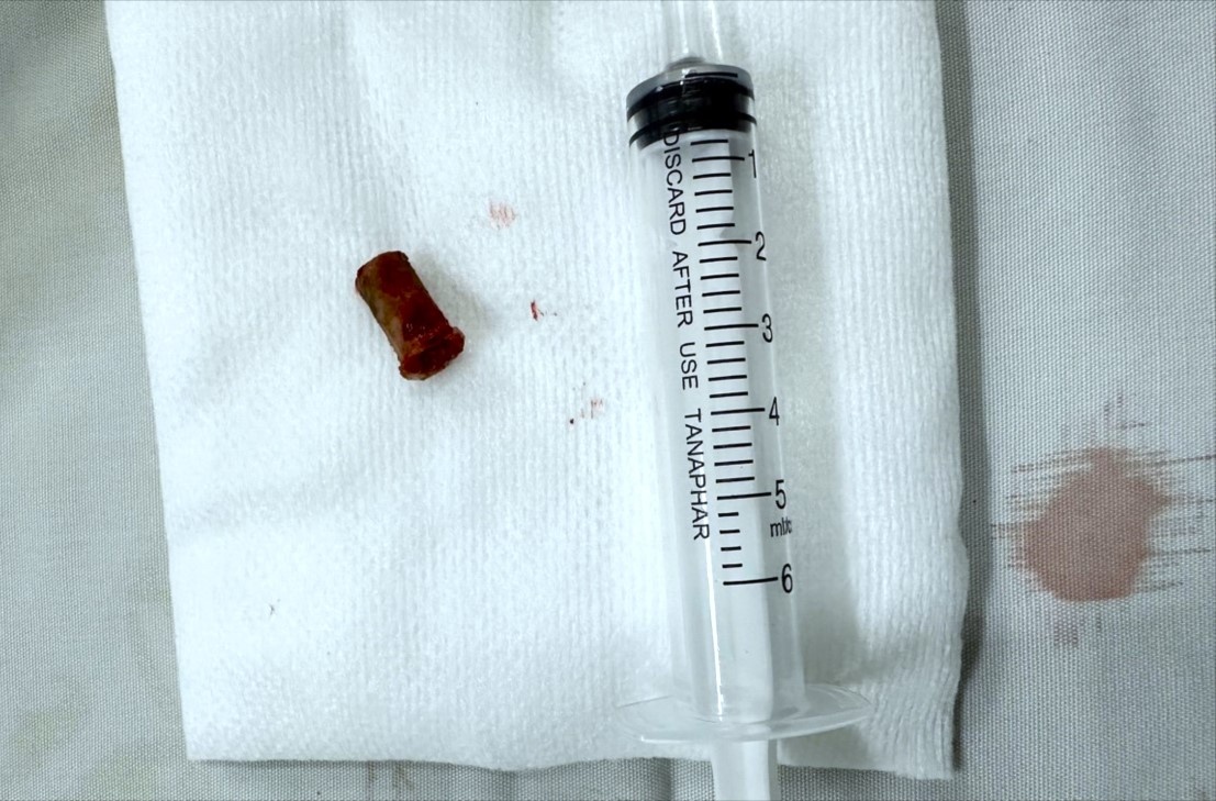 Bi ket di vat trong phoi suot 7 nam, di 5 benh vien moi lay ra duoc hinh anh