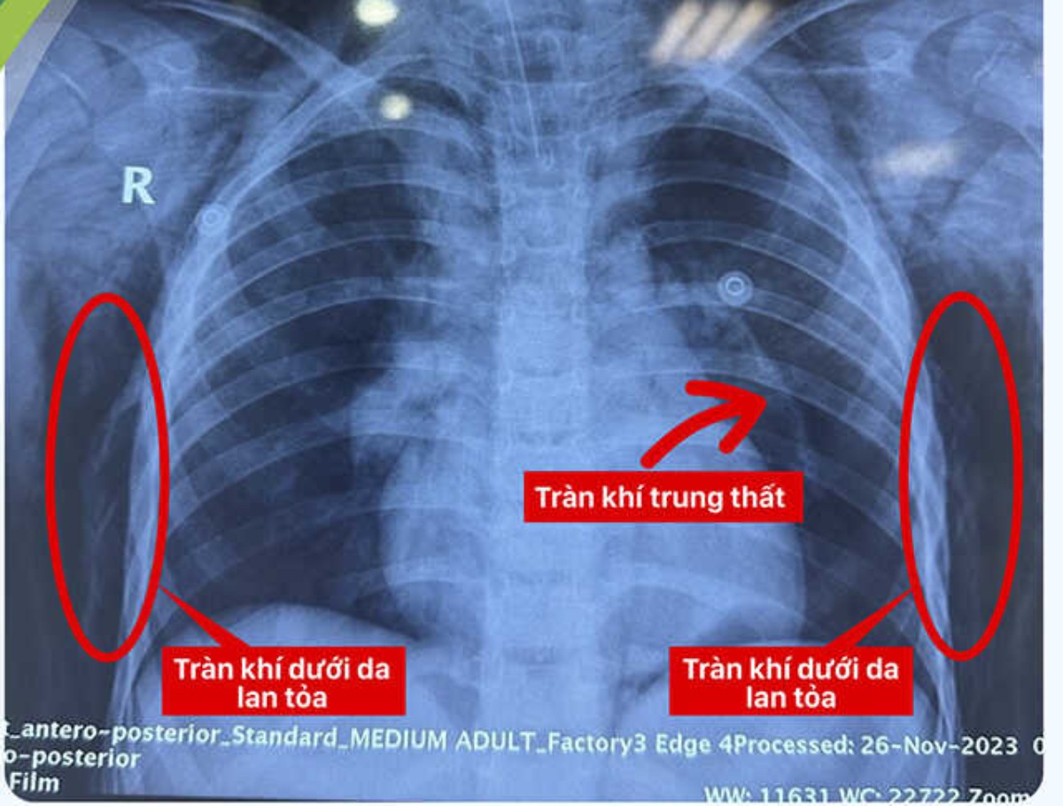 nga vo khi quan anh 1