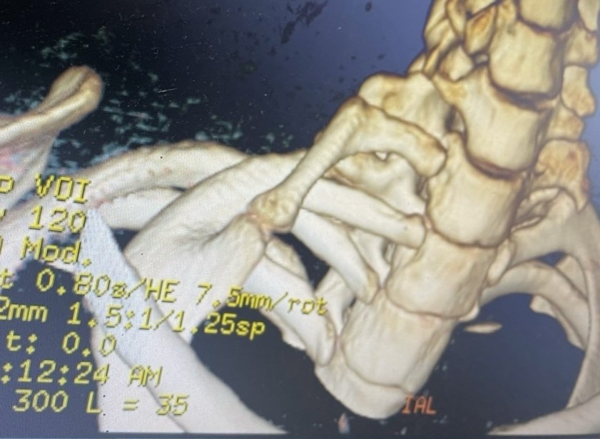 Ky la co gai 22 tuoi co xuong suon moc o co hinh anh