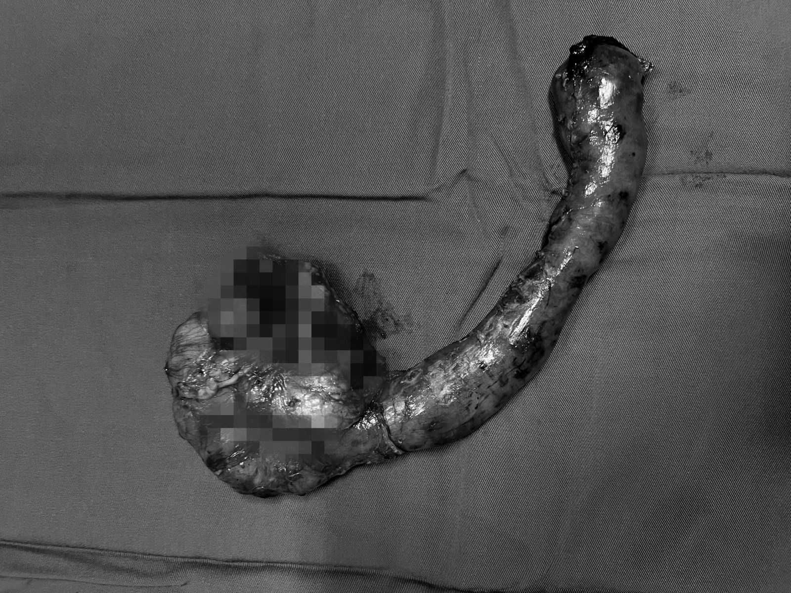 ung thu tuyen tuy anh 1