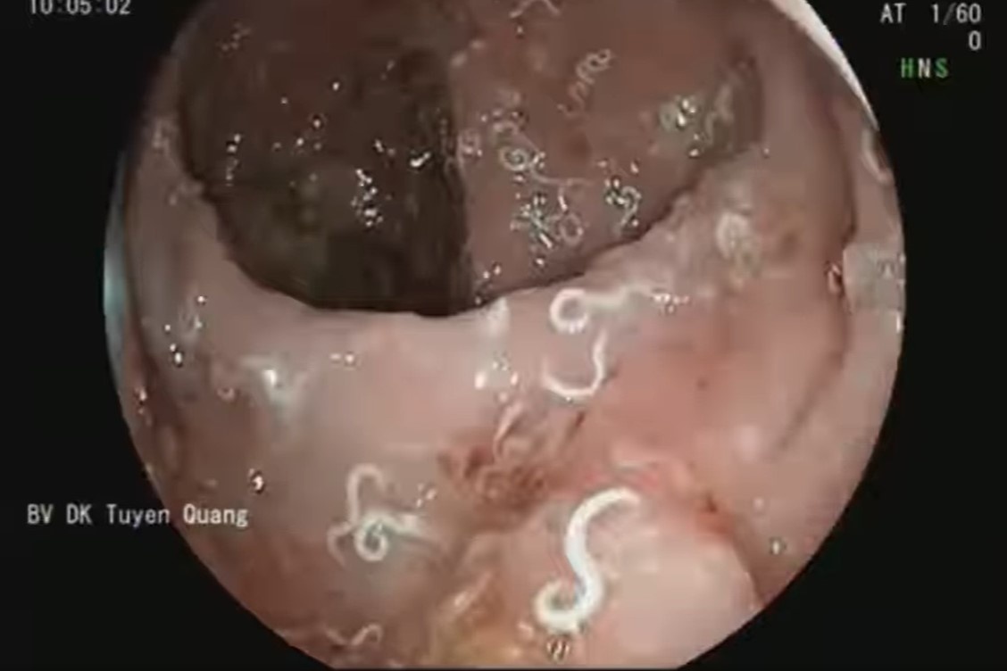 giun kim trong dai trang anh 1