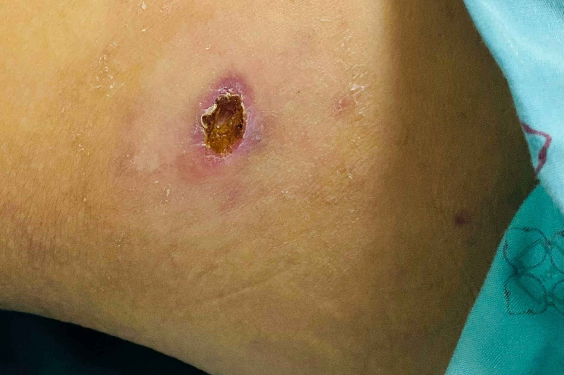 Vet loet nho tren da canh bao can benh nguy hiem hinh anh