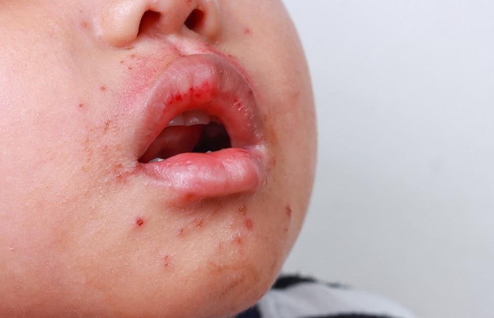 Can benh truyen nhiem hay tai di tai lai o tre hinh anh