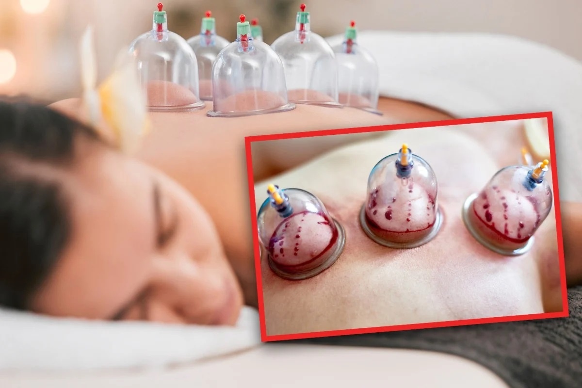 Mot phu nu Trung Quoc nhap vien sau khi hut 200 ml mau moi tuan hinh anh