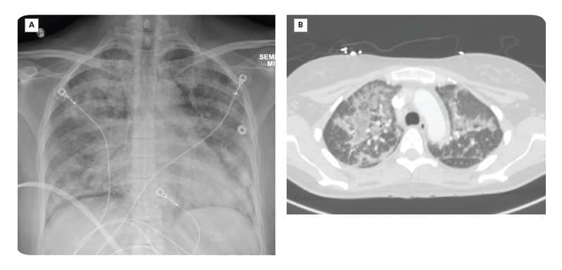 viem phoi nang anh 1
