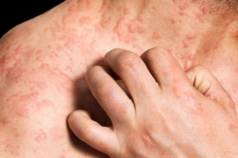 Viem da di ung co phai chi do di ung? hinh anh