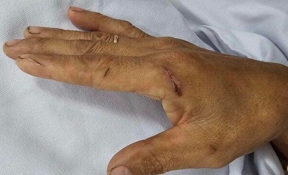 Nhiem lien cau lon vi dung tay bi thuong boc thit hinh anh