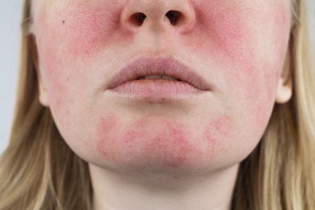 Vi sao ban do bung mat du chi uong mot ngum bia? hinh anh