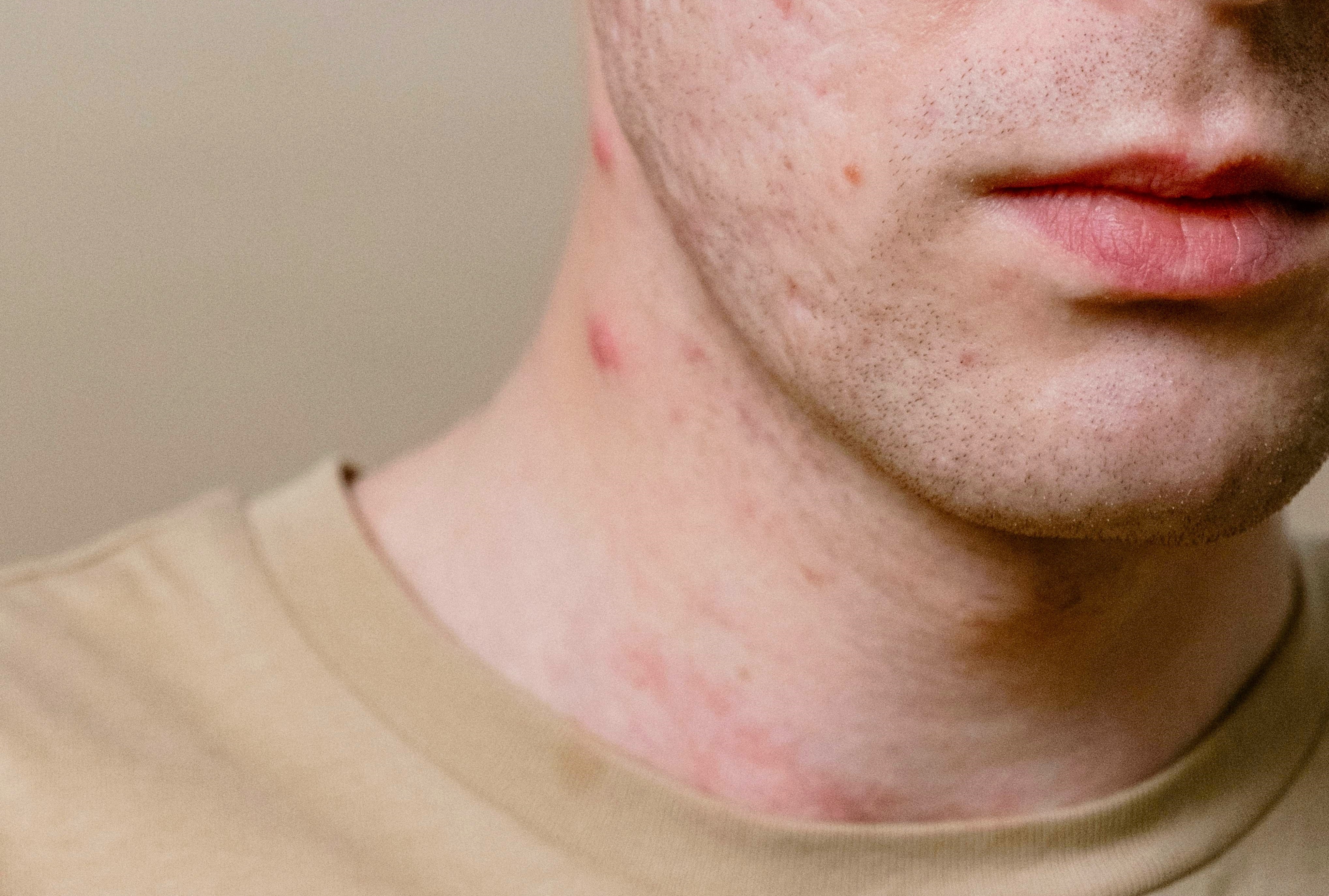 Ca nghi mac dau mua khi dau tien tai Ca Mau hinh anh