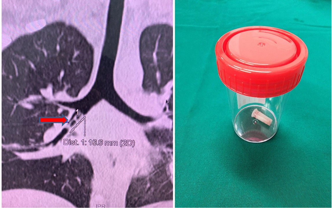 ket di vat phe quan anh 1