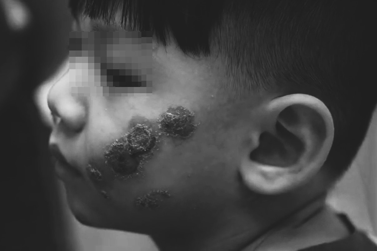 bệnh da liễu ảnh 1 benh da lieu anh 1