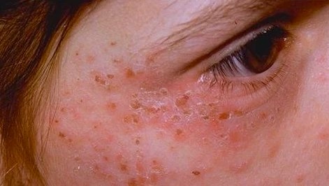 Co gai 20 tuoi mac benh 'ma ca rong' hinh anh