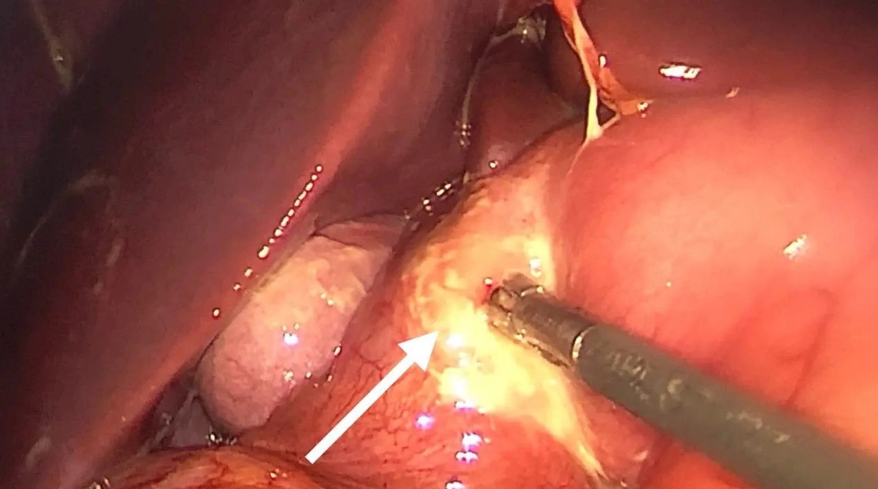 nam sinh thung da day anh 1