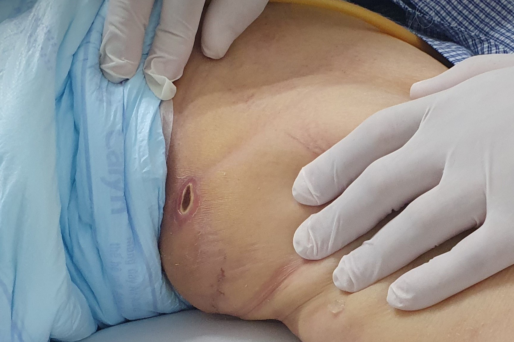 Can benh nguy hiem bat dau tu vet loet nho hinh anh