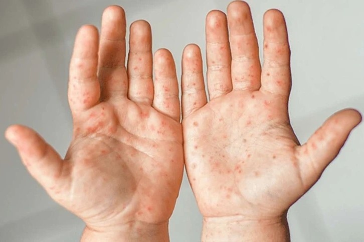 Diem khac biet cua vet ban tay chan mieng va thuy dau hinh anh