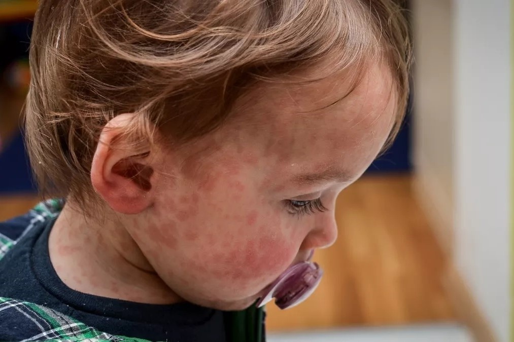 Tung 'mien nhiem', nay soi bung phat tai Anh hinh anh